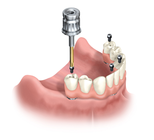 Full mouth implant treatment