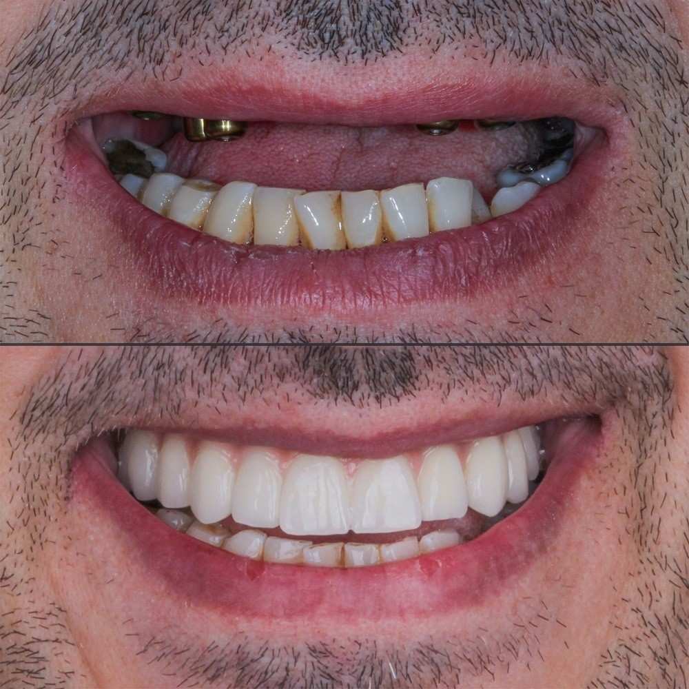 all on 4 before and after