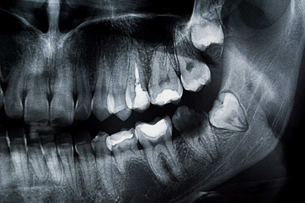 teeth x ray