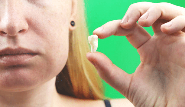 wisdom tooth removal