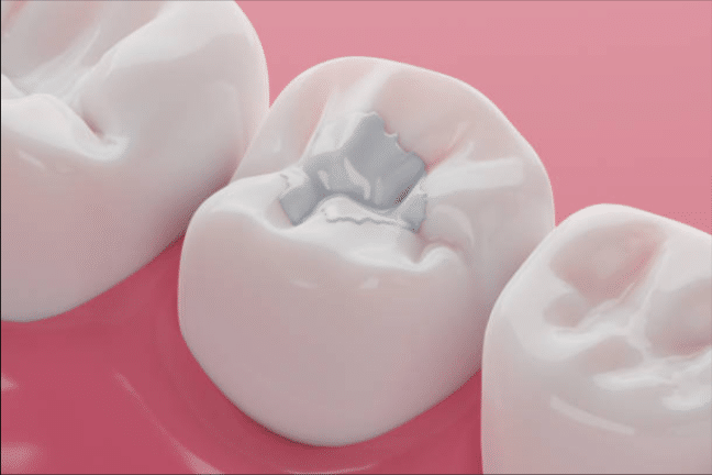 Composite Filling