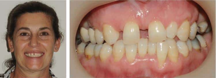 before orthodontics treatment