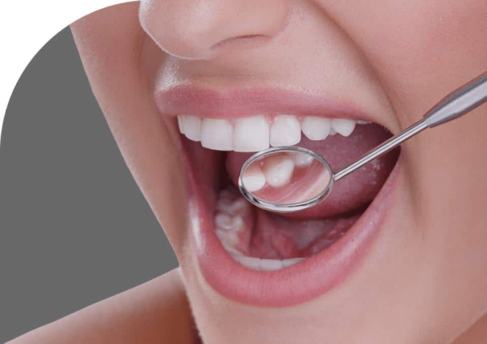 composite white filling