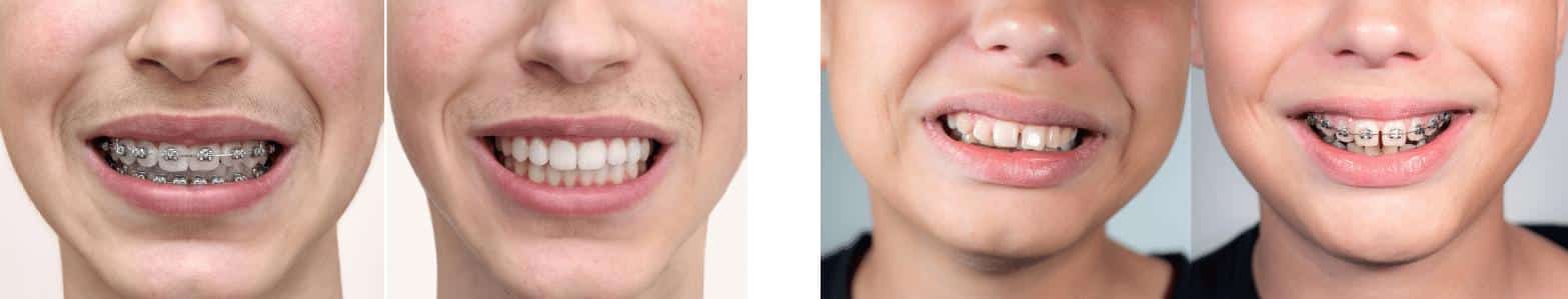 braces treatment