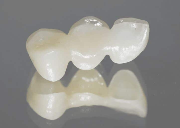 crown and bridge treatment