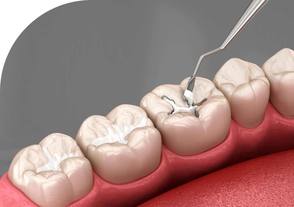 Fissure Sealant Treatment