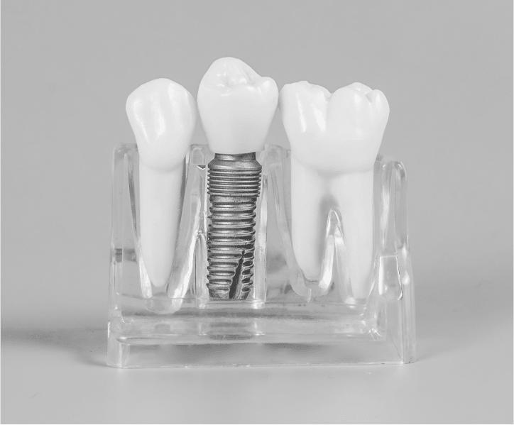 dental implant