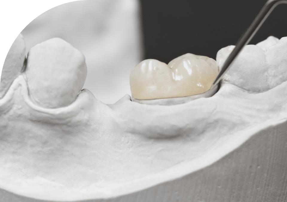Inlays and Onlays Dental