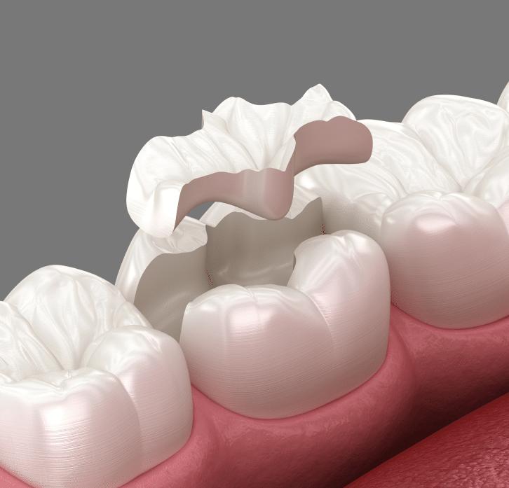 Inlays and Onlays Dental