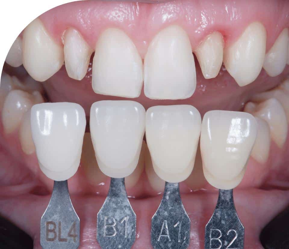 high quality veneers