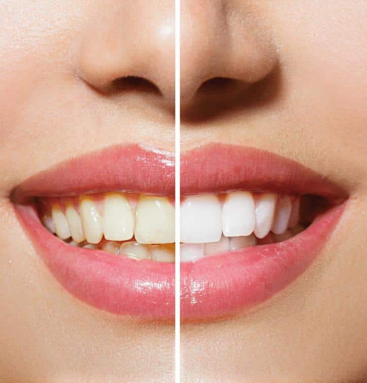 In-Chair Tooth Whitening