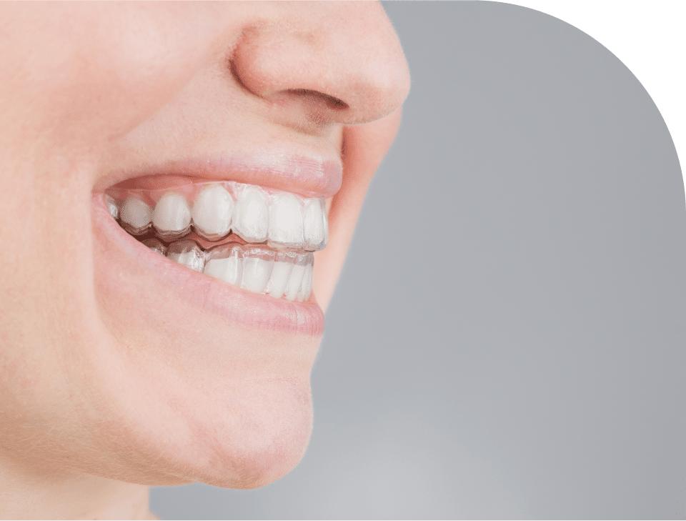 Invisalign clear aligners