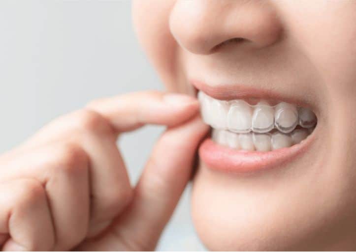 women placing her aligners
