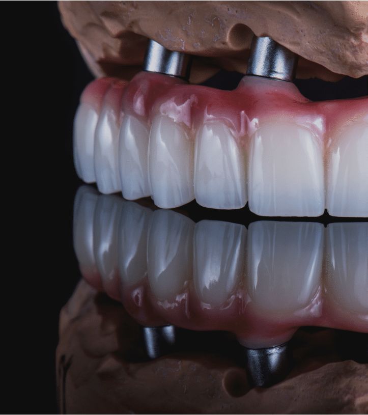 full mouth implants