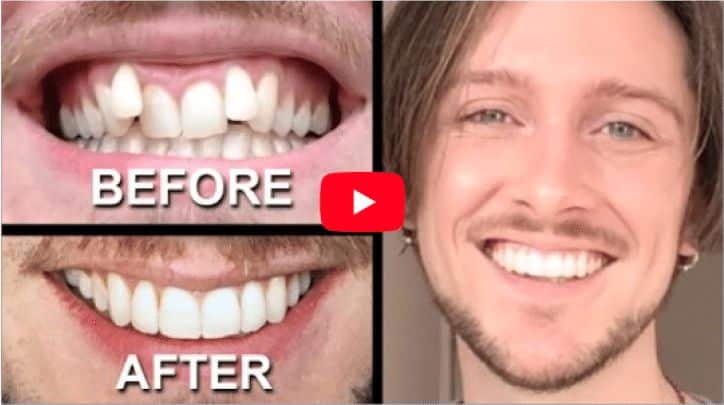invisalign review