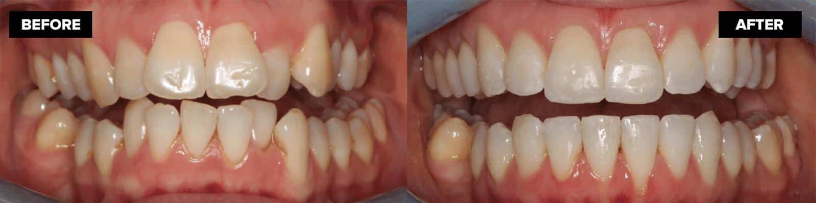 before and after aligners treatment