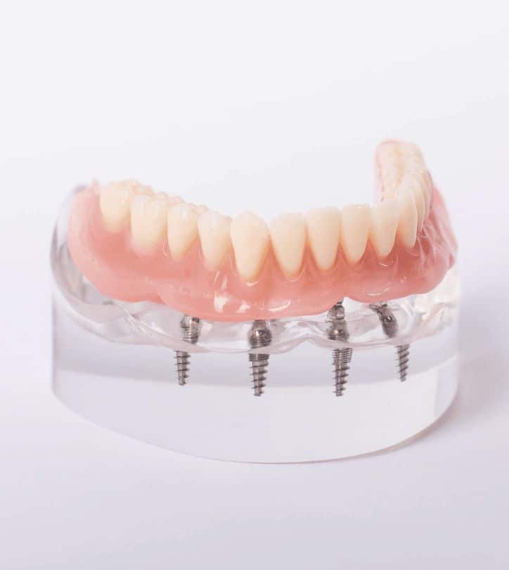 All On 4 Implants