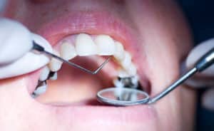 Genetic testing for tooth decay risk