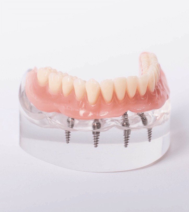 All On 4 Implants