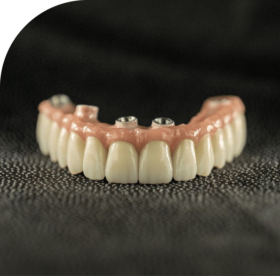 full arch implant