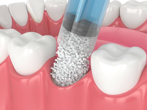 What is Dental Bone Grafting?