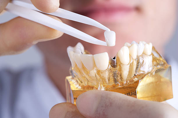 How Painful is a Dental Implant REALLY?